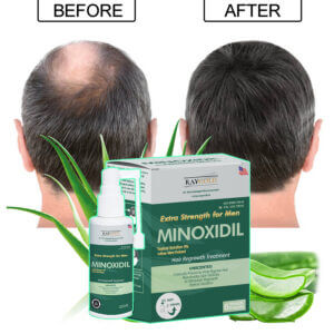 Minoxidil penumbuh rambut 