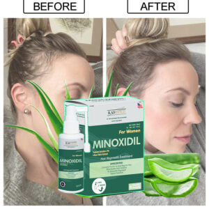 Minoxidil penumbuh rambut for women with aloe vera atau lidah buaya